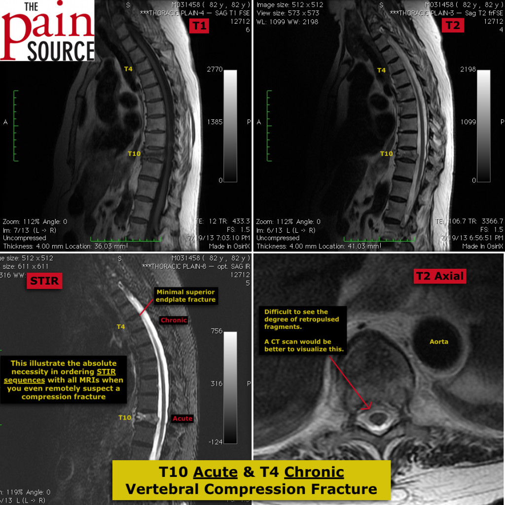 T10 acute and T4 chronic vertebral compression fracture - The Pain Source