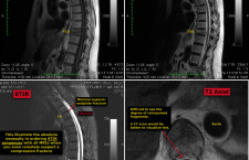 T10 acute and T4 chronic vertebral compression fracture – The Pain Source