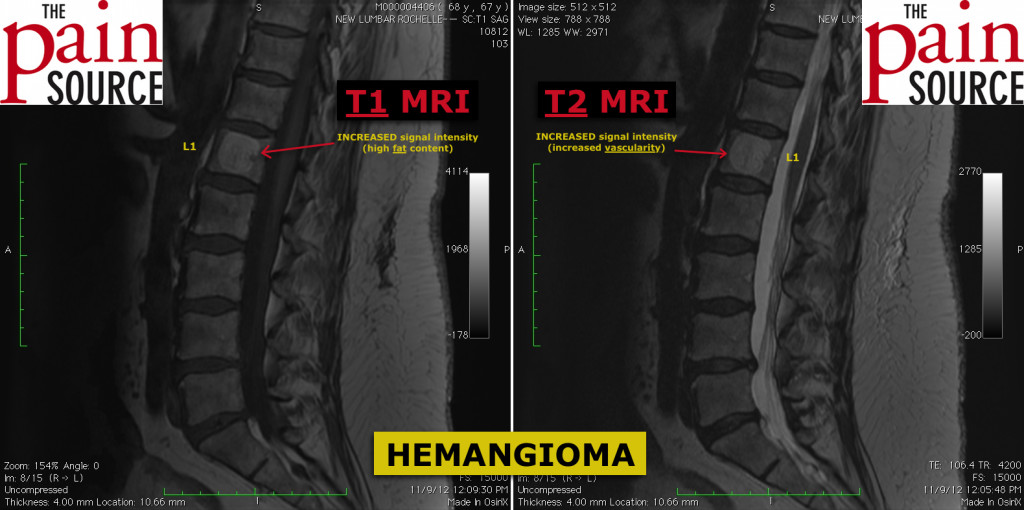 Hemagioma in L1 vertebral body - The Pain Source