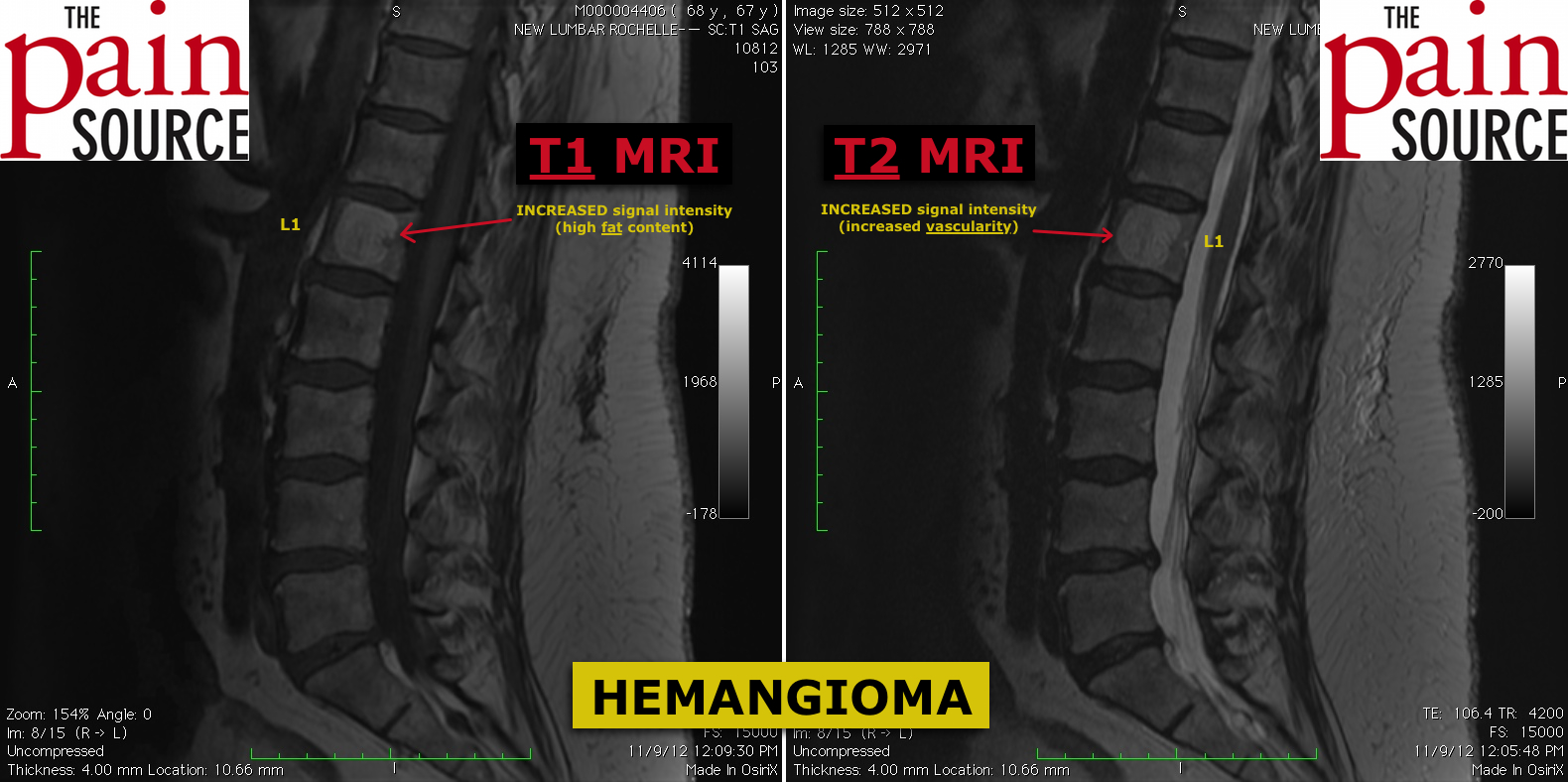 Quotminquot Vertebral Hemangioma Vertebral Angioma Symptoms