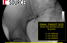 Piriformis Injection With Fluoroscopy – intermediate step