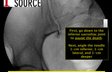 Piriformis injection under fluoroscopy – intermediate step 1