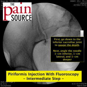 Advance down to the inferior end of the posterior SI joint opening to gauge depth.