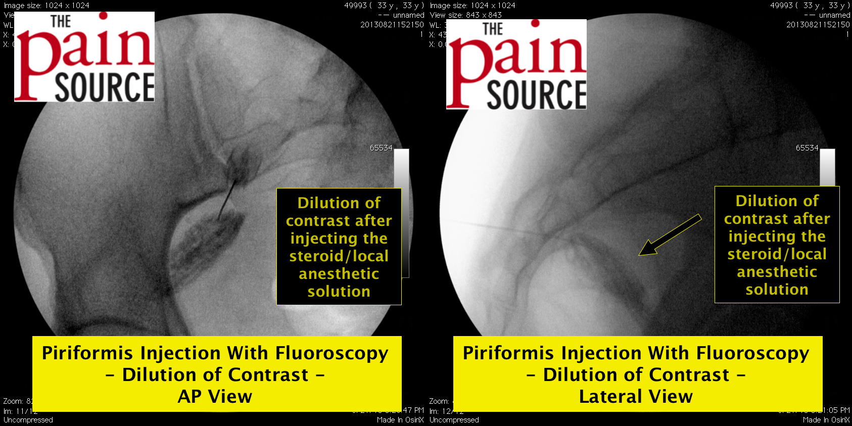 Piriformis Muscle Injection With Fluoroscopy The Pain Source Makes Learning About Pain Painless