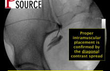 Piriformis injection with fluoroscopy – contrast spread