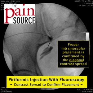 Inject contrast to see the diagonal flow pattern of the piriformis muscle.