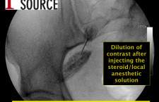 Piriformis injection with fluoroscopy – dilution of contrast