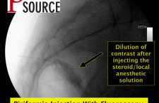 Piriformis injection with fluoroscopy – lateral view