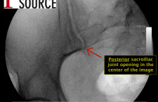 Piriformis injection with fluoroscopy – starting image