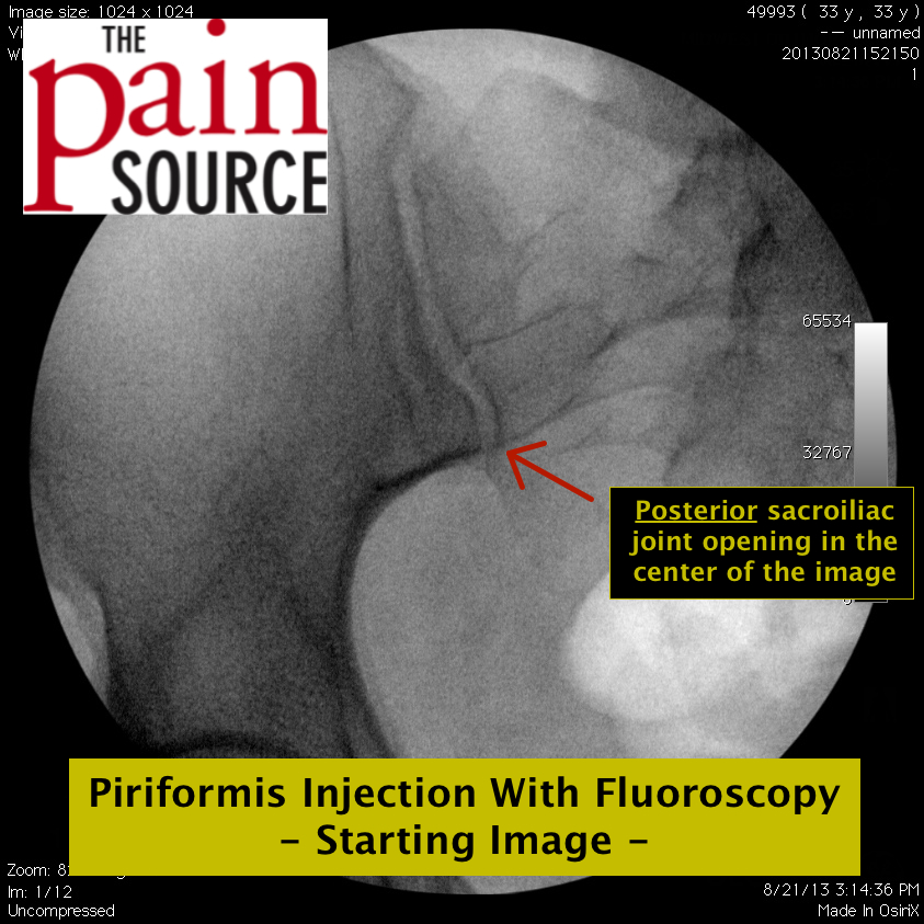 Piriformis Injection  Excel Pain and Spine