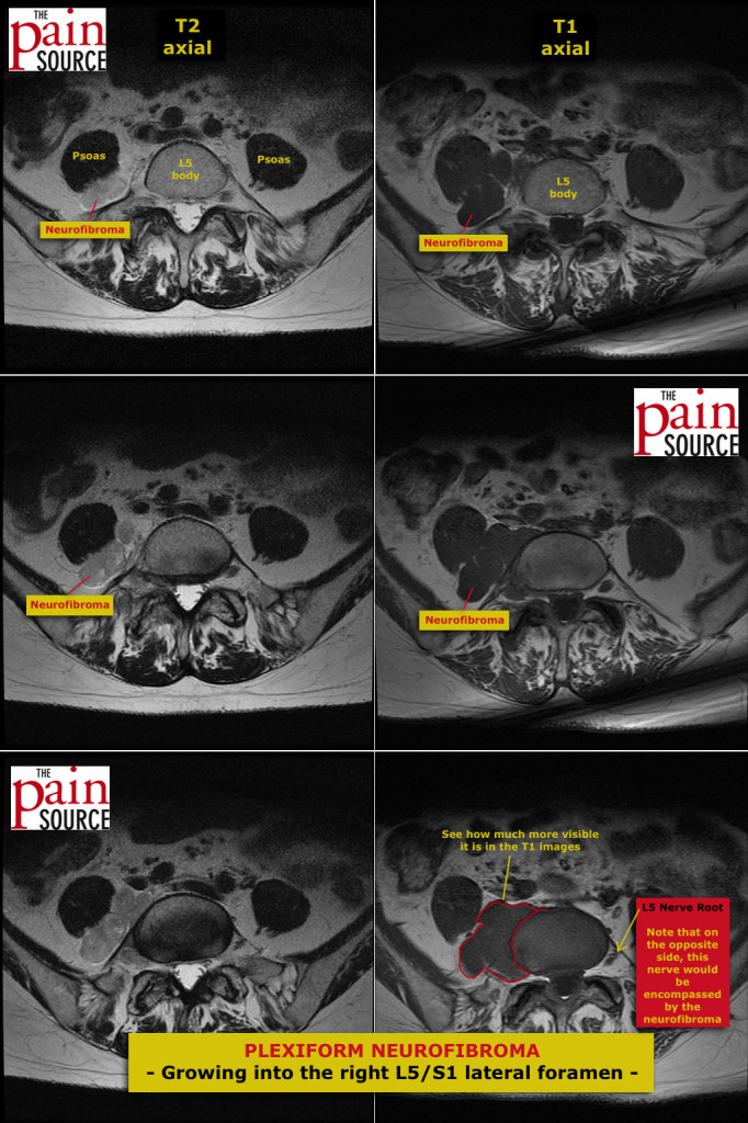 Plexiform neurofibroma - six images