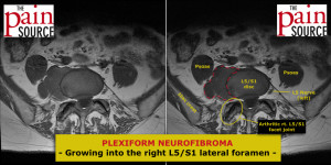 Plexiform neurofibroma - two images