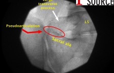 Bartolotti’s syndrome