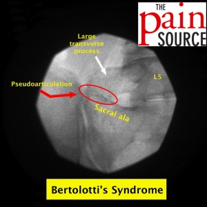 Bartolotti's syndrome