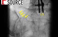Bartolotti’s syndrome injection