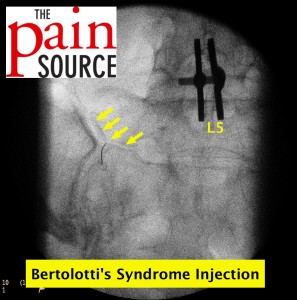 Bartolotti's syndrome injection