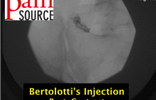 Bertolottis syndrome injection – post contrast