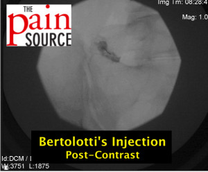 Bertolottis syndrome injection - post contrast