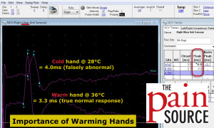 Importance of Warming Hands for NCS - ulnar nerve - The Pain Source