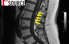 Lumbar filum terminale fibrolipoma – T1 MRI