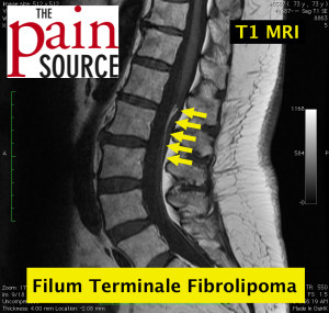Lumbar filum terminale fibrolipoma - T1 MRI
