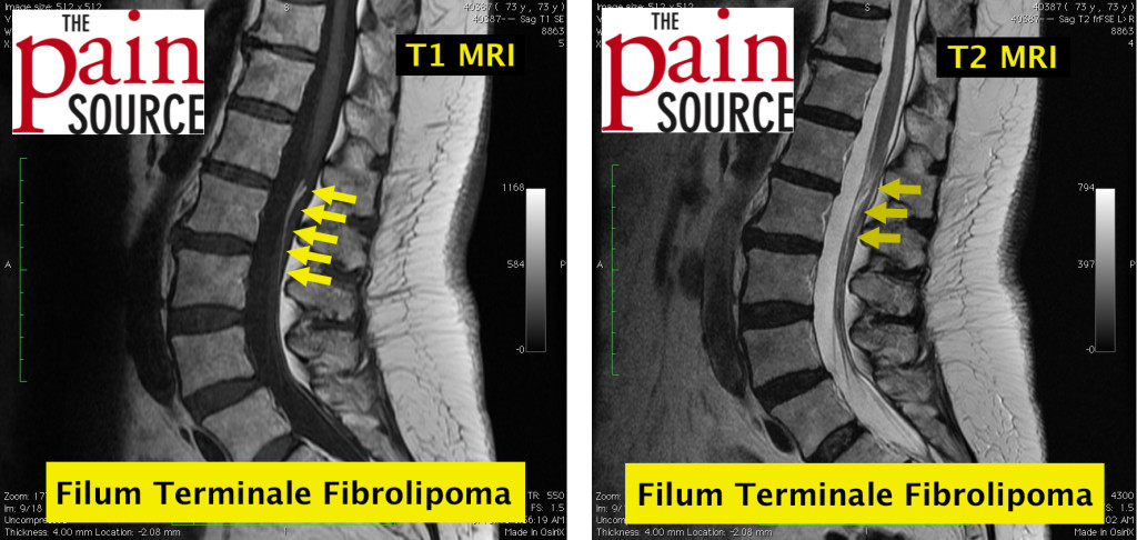 Lumbar filum terminale fibrolipoma - T1 and T2 MRI