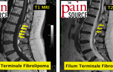 Lumbar filum terminale fibrolipoma - T1 MRI - The Pain Source