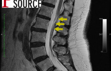 Lumbar filum terminale fibrolipoma – T2 MRI