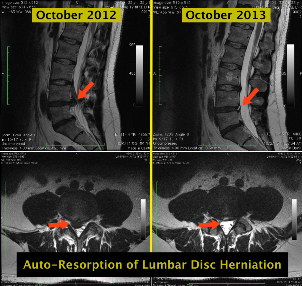 Resorption of lumbar disc herniation
